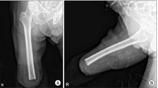 Fig. 5. Radiographs of the right femur after  above­knee amputation: anteroposterior  (A) and lateral (B).