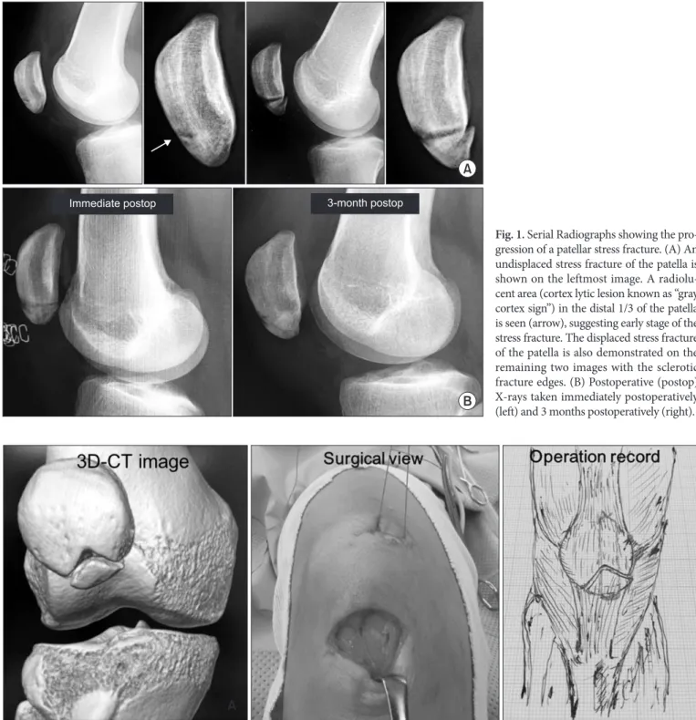 Fig. 1. Serial Radiographs showing the pro­