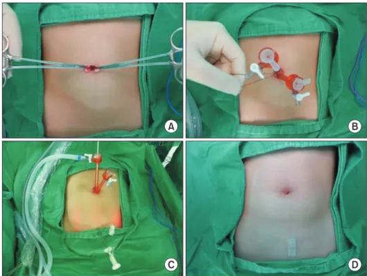 Fig. 1. Operation field of Single-incision  two-port laparoscopic appendectomy  (SITPLA)