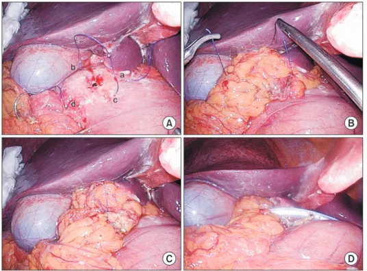 Fig. 2. Figure of eight suturing around  a perforated duodenal ulcer, in the order  of a, b, c, and d (A)