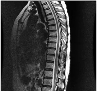 Fig. 1. The spinal magnetic resonance imaging (MRI) demonstrated diffuse, ill-defined high signal intensities at the T8-10 level on a T2 sagittal image.