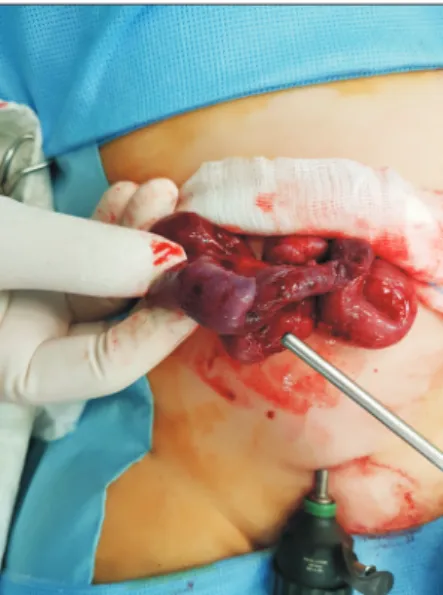 Fig. 1. Conversion to laparotomy for irreducible intussusception through  umbilical incision.
