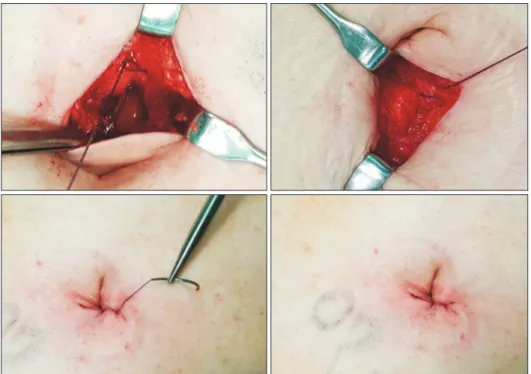 Fig. 1. Abdominal wall closure from the  fascia to the skin was performed with a  single 23 cm thread of V-Loc 90 including  two layered overlapping fascia closure,  subcutaneous fat approximation, and a  continuous intradermal suture after  sin-gle incisi