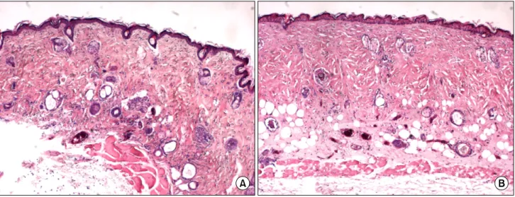 Fig. 1. Structures  of  normal  and  burned  skin  in  hairless  mice.  (A)  Normal  skin  showed  the  epidermis  and  dermis