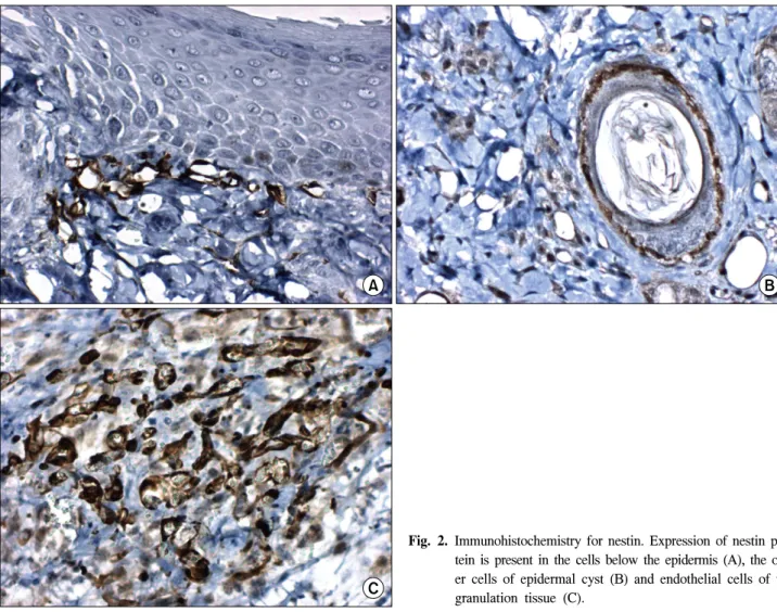 Fig. 2. Immunohistochemistry  for  nestin.  Expression  of  nestin  pro- pro-tein  is  present  in  the  cells  below  the  epidermis  (A),  the   out-er  cells  of  epidout-ermal  cyst  (B)  and  endothelial  cells  of  the  granulation  tissue  (C)