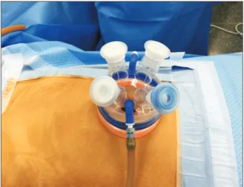 Fig. 1. Glove port used for single incision laparoscopic appendectomy.