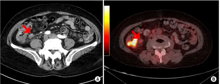 Fig.  1.  (A)  Computed  tomography  (CT)  transaxial  image.  Preoperative  CT  shows  irregular  wall  thickness  and  pericolic  fat  infiltration  of  ascending  colon  and  pericolic  lymph  node  (LN)  enlargement