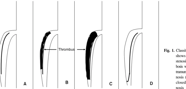 Fig.  1.  Classification  of  CT  findings  shows  double  lumen  without  stenosis  (A),  intramural  throm-bosis  without  stenosis  (B),   in-tramural  thrombosis  with   ste-nosis  (C),  double  lumen  with  closed  false  lumen  and   ste-nosis  (D).것