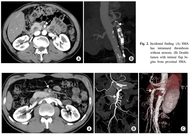 Fig.  2.  Incidental  finding.  (A)  SMA  has  intramural  thrombosis  without  stenosis