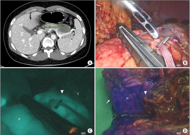 Fig. 1. (A) Preoperative image: 4.5 cm mass in the pancreas tail. (B) Before pancreas resection (bare eye view), (C) before pancreas resection (ICG- (ICG-fluorescent pancreatic perfusion-guidance view), and (D) Immediate postoperative specimen (ICG-(ICG-fl