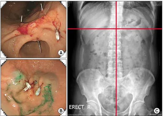 Fig.  1.  (A)  Endoscopic  clipping  at  proximal  and  distal  margin  of  the  lesion