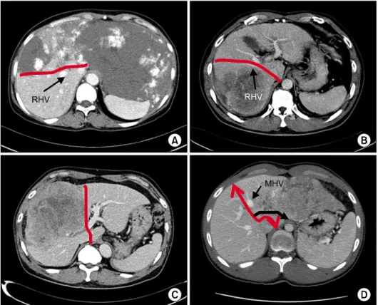 Fig. 2. (A)  CT  finding  of  a  large  hemangioma  occupying  central  and  left  liver
