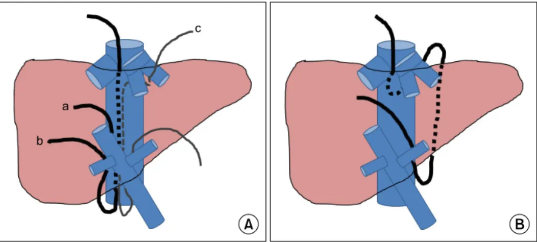 Fig. 3. Various  direction  of  hanging  tape  during  various  hepatectomy.  (A)  The  ‘a’  tape  was  used  during  right  lobectomy  or  left  lobectomy＋