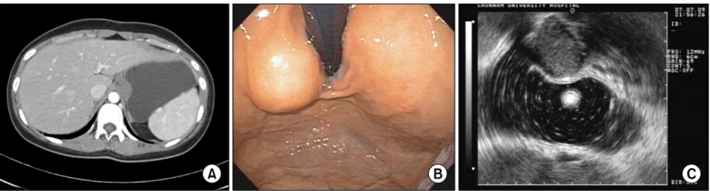 Fig. 1. Abdomen CT, endoscopic gastroduodenoscopy (EGD) and endoscopic ultrasound (EUS) show submucosal tumors in gastric cardia.