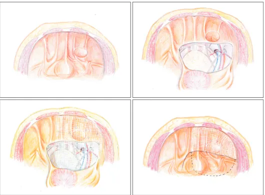 Fig. 2. Extended indication for lower  lateral abdominal hernia, where the  com-posite mesh over inferior lateral aspect  (triangle of Doom and triangle of pain) is  only fixed by overlaying peritoneal flap  repositioned.