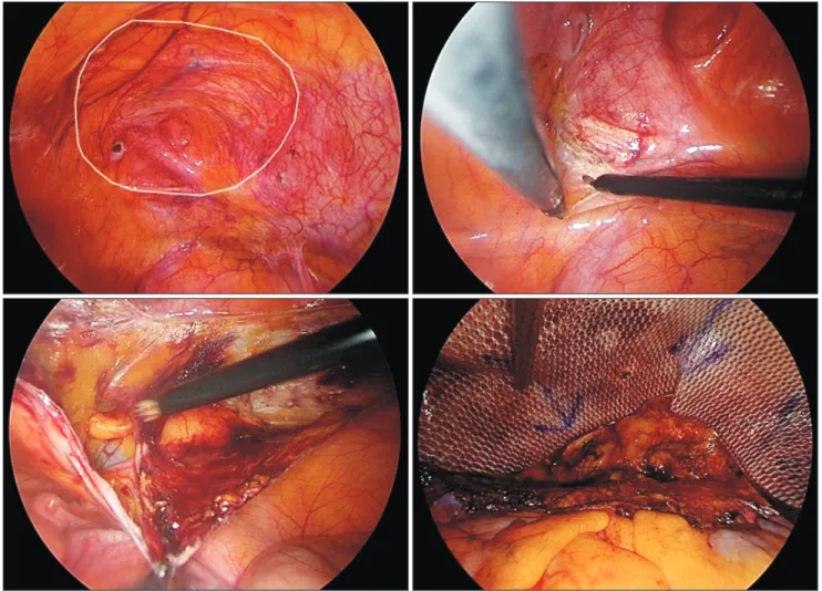 Fig. 4. Post TRAM flap donor site hernia over right lower abdomen, with peritoneal dissection started right below the edge of defect, and exposure  of pre-peritoneal space over right side with round ligament and iliac vein exposed
