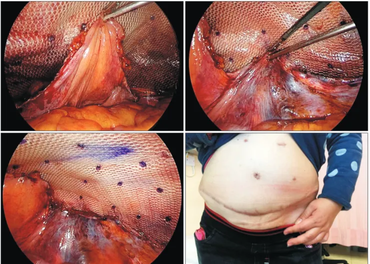 Table 5. Patients’ demographics and operative details of lateral lower abdominal hernia