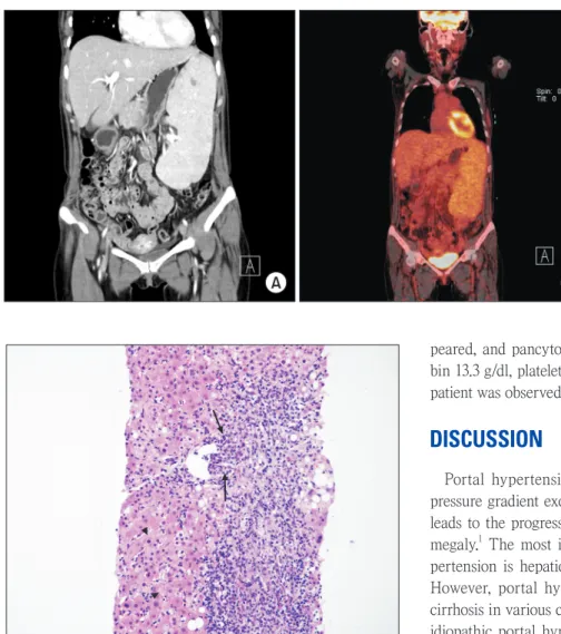 Fig. 1. (A) Initial CT finding; Contrast  enhanced abdominal CT shows marked  spleen enlargement with multifocal  sp-lenic infarct and suspicious of lymphoma  involvement or other hematologic  di-sor der