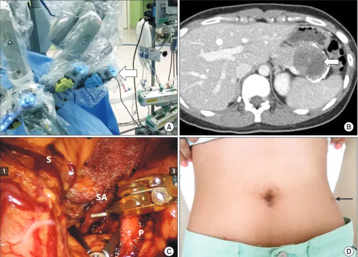 Fig. 2. Technical innovation of the robotic surgical system for LSP/RP DP. Robot setting for robotic single-site plus ONE port DP