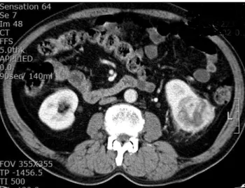 Fig. 3. Computed tomography scan shows left renal cell carcinoma.