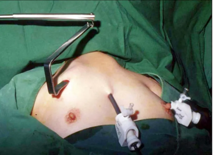 Table  1.  Pathologic  diagnosis Pathology Open (n=747) Endoscopic(n=402) Total  (n=1,149) Benign 　Nodular  hyperplasia 328 203 531 　Follicular  adenoma 39 24 63 　Grave’s  disease 4 5 9 　Lymphocytic  thyroiditis 6 5 11 　Hashimoto’s  thyroiditis 8 4 12