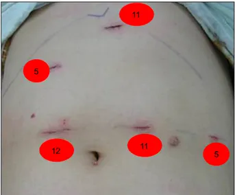 Fig. 1. Laparoscpic  sleeve  gastrectomy  was  performed  using  5  trocars.  The  position  and  size  of  trocars  are  illustrated.