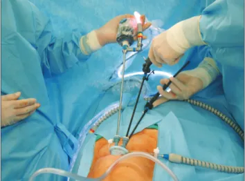Fig. 1. Single-port with the camera inserted into the 5-mm port along  with laparoscopic instruments