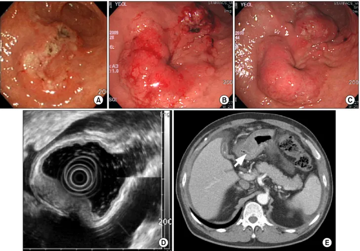 Fig.  1.  Endoscopic  and  abdominal  CT  finding.  (A)  10  months  before  surgery,  endoscopic  view  of  4  cm  sized  ulcerofungating  mass-like  lesion  is  noted  on  the  low  body  with  irregular  base