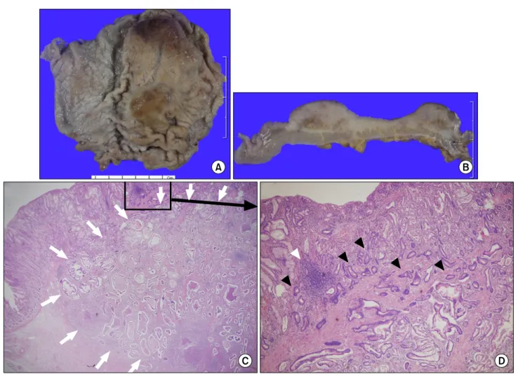 Fig.  2.  Pathologic  finding.  (A)  Gross  finding:  The  mucosal  surface  of  the  whole  body  shows  a  dome-shaped  elevated  lesion,  measuring  8.5×6.5  cm