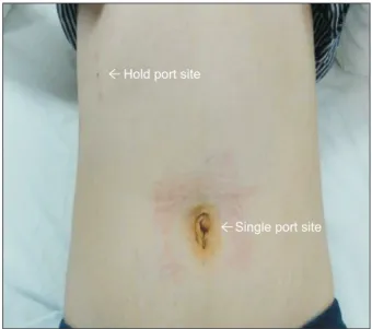 Fig. 4. Hold port site shows minimal scar.