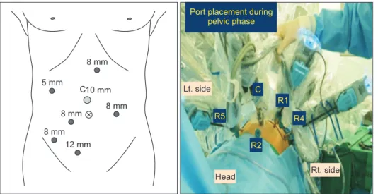 Fig. 3. Patient setup and port placement.