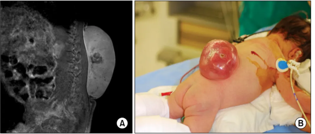 Fig.  2.  (A)  Sagittal  T2  weighted  MR  image  reveals  a  hyperintense  homogenous,  well  defined  mass  on  the  back  without  connection  to  spinal  canal