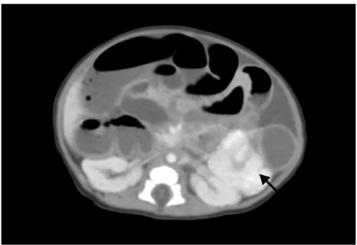 Fig.  3.  Abdominal  CT  scan  shows  a  3.5  cm  hyperdense  mass  at  the  splenic  flexure,  which  developed  bowel  obstruction.
