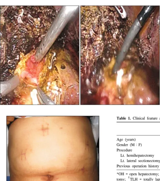 Fig.  3.  After  liver  resection,  using  the  suction  device  and   cath-eter,  remnant  bile  duct  stone  removed  as  many  as   possi-ble,  and  then   choledoco-scopy  was  inserted  to   re-sected  bile  duct.