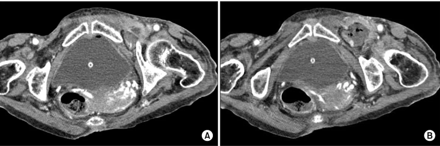 Fig.  1.  Abdominal  CT  scan  of  obturator  hernia.  (A)  Small  bowel  segment  heniates  through  left  obturator  canal