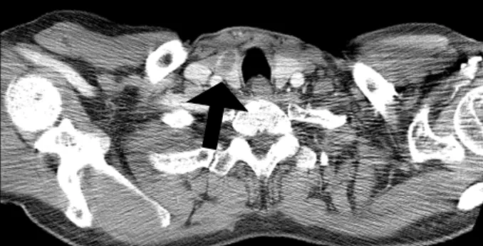 Fig.  1.  Contrast-enhanced  chest  CT  scan  shows  hypodense  nodule  in  right  thyroid  gland  (black  arrow)