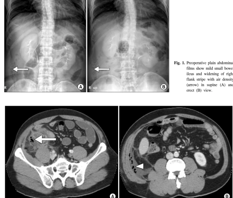 Fig.  2.  Preoperative  computed  tomography  scan  of  the  abdomen  and  pelvis  demonstrates  ill-defined  appendix  and  periappendiceal  abscess  formation  with  internal  air  density  (arrow)  (A)