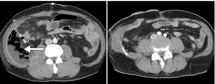 Fig.  3.  Computed  tomography  scan  shows  markedly  enlarged  abscess  cavity  in  right  posterior  pararenal  space  of  the  retroperitoneum  (arrow),  1  week  after  1st  operation  (A),  but  retroperitoneal  abscess  cavity  is  near  complete  a