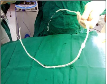 Fig. 1. The  Guardix-sol  Application.  The  continuous  ambulatory  peritoneal  dialysis  catheter.