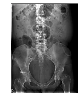 Fig. 3. The  simple  abdomen  X-ray  shows  a  continuous  ambula- ambula-tory  peritoneal  dialysis  catheter  malposition.