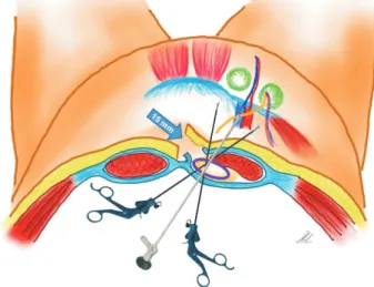 Fig. 1. Schematic illustration of conventional TEP. Fig. 2. Schematic illustration of single incisional TEP.
