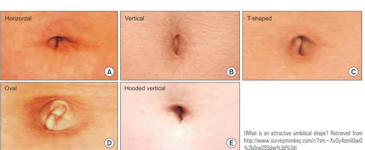 Fig. 1. Single Umbilical Tangential In- In-cision. The tangential skin incision was  performed at the hidden lateral surface  of the umbilical crater