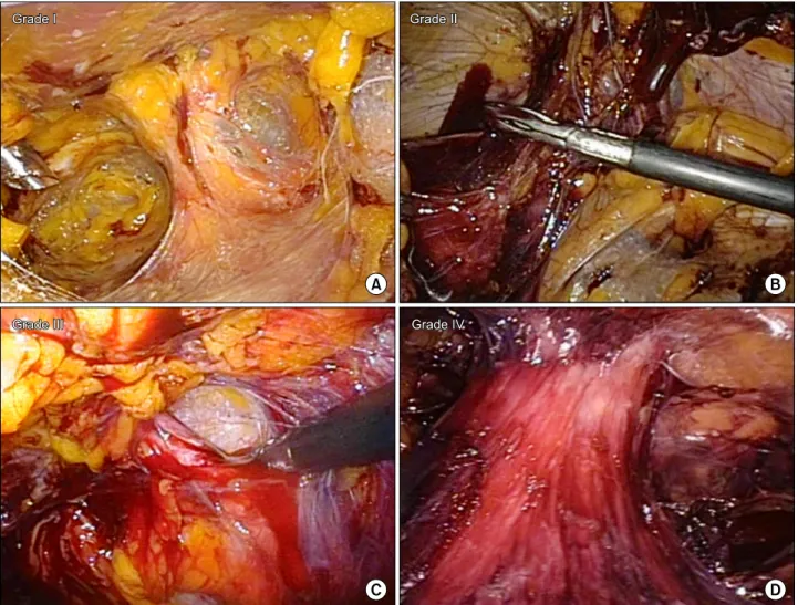 Fig.  1.  Semiquantitative  grading  system  of  the  bloodstain.  (A)  Grade  I:  Grade  I,  less  than  a  quarter  of  the  tissue  in  the  screen  stained  with  blood,  (B)  Grade  II:  less  than  half  of  the  tissue  stained,  (C)  Grade  III:  l