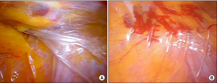 Fig.  2.  View  of  preperitoneal  space  under  blunt  dissection.  (A)  View  from  inside  of  the  balloon  dissector