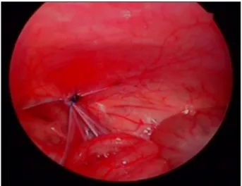 Fig.  1.  Pre-repair  laparoscopic  view  of  opened  hernia  sac. Fig.  2.  Post-repair  laparoscopic  view  of  opened  hernia  sac.