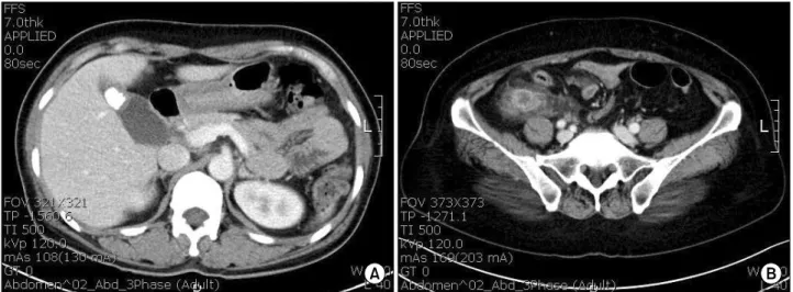 Fig.  1.  Computed  tomography  revealed  about  1.7  cm  sized  stone  in  the  gall  bladder
