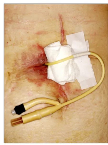 Fig. 2. Inserted Foley catheter into leaking site and drainage of  leaked content in a patient with leakage in the duodenal  stump after distal gastrectomy.