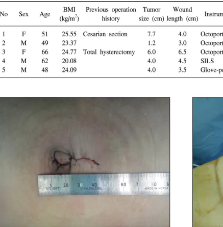 Fig.  1.  The  postoperative  transumbilical  wound. Fig.  2.  An  OCTO  port.