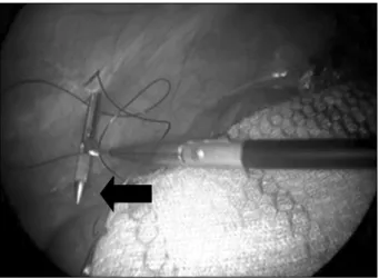 Fig.  2.  Additive  fixation  of  mesh  by  metal  tacker  after  transfascial  fixation