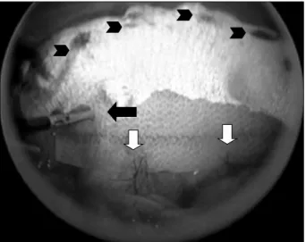 Fig.  3.  Intraabdominal  view  after  completion  of  mesh  fixation. 